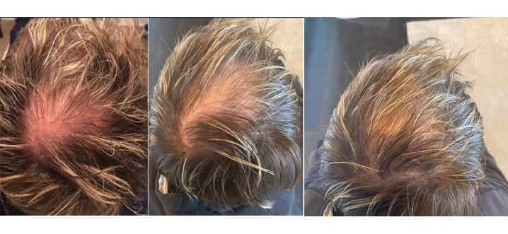 Hair Loss | Lasting Impression - Client Results
