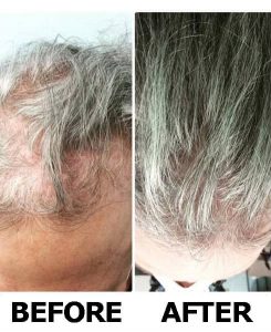 Hair Loss | Lasting Impression - Client Results 02