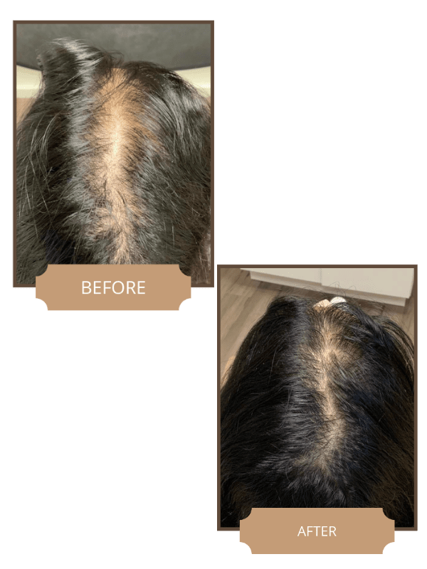 Hair Loss | Lasting Impression - Before & After 06