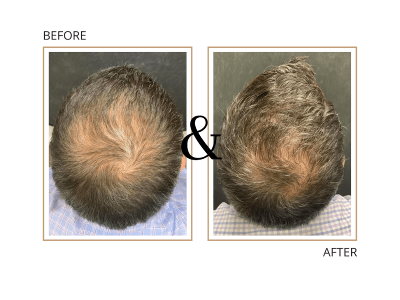 Hair Loss | Lasting Impression - Before & After 04