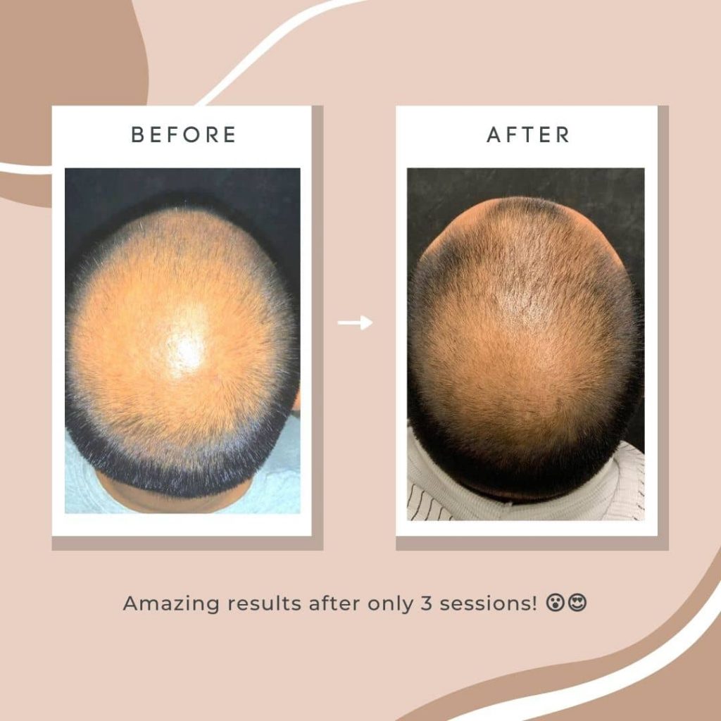 Hair Loss | Lasting Impression - Before & After 01