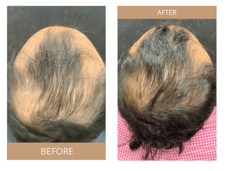Hair Loss | Lasting Impression - Before & After 02