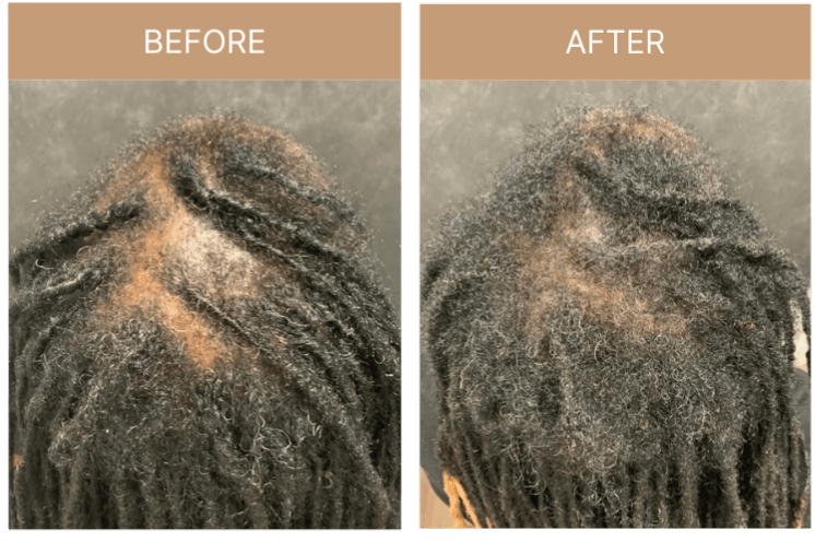 Hair Loss | Lasting Impression - Before & After 03