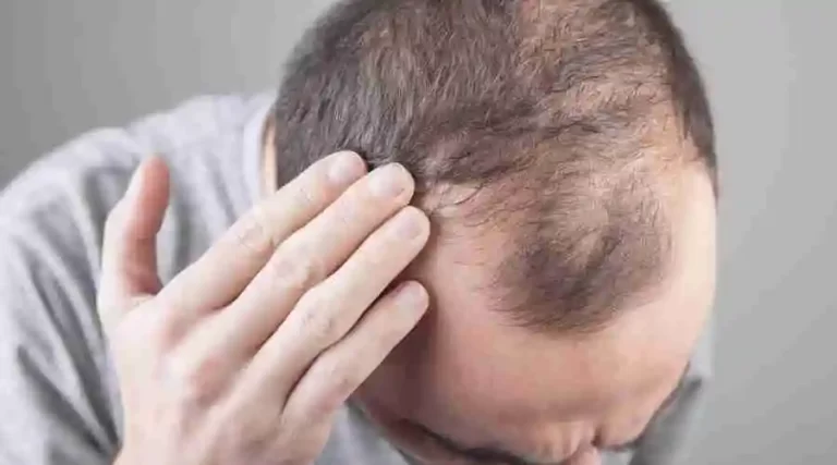 The Finish Line for Baldness? Researchers Have Identified the Chemicals that Control Life and Death in Hair Follicles