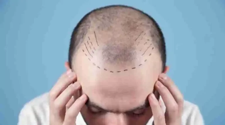 Myths About Why People Go Bald