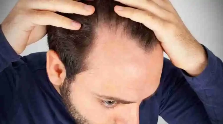 Options For Treating A Receding Hairline