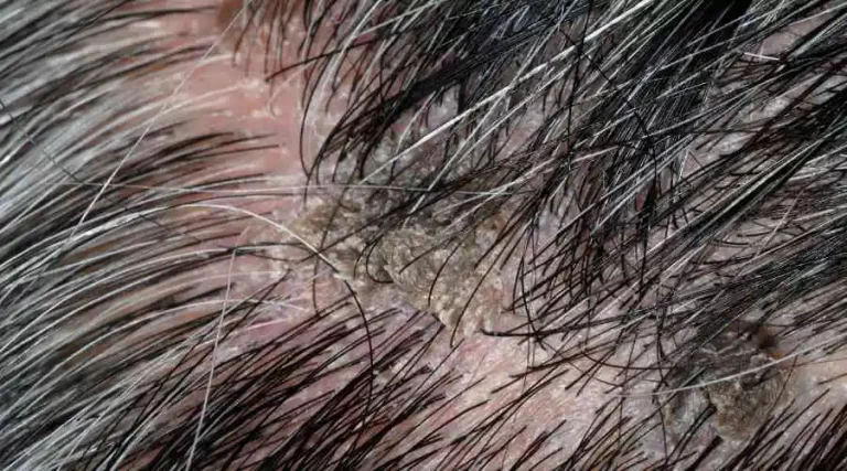 PSORIASIS VS. DANDRUFF: WHAT ARE THE SIGNS, CAUSES, AND TREATMENT
