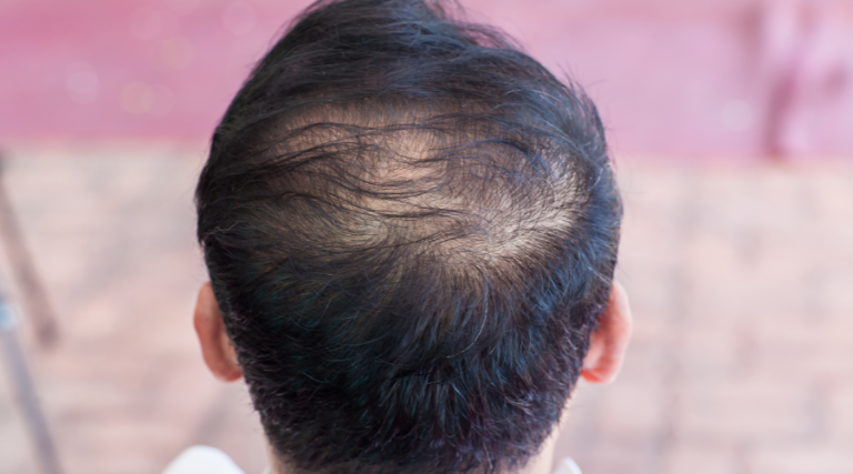 Hair loss men