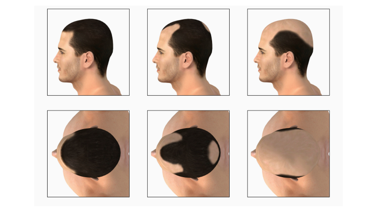 Pattern Baldness