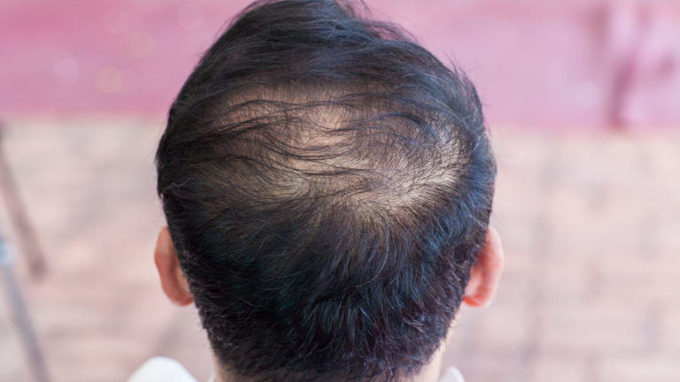 effects hair loss