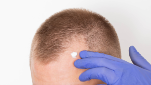 Ideal Candidate for Hair Restoration Therapy